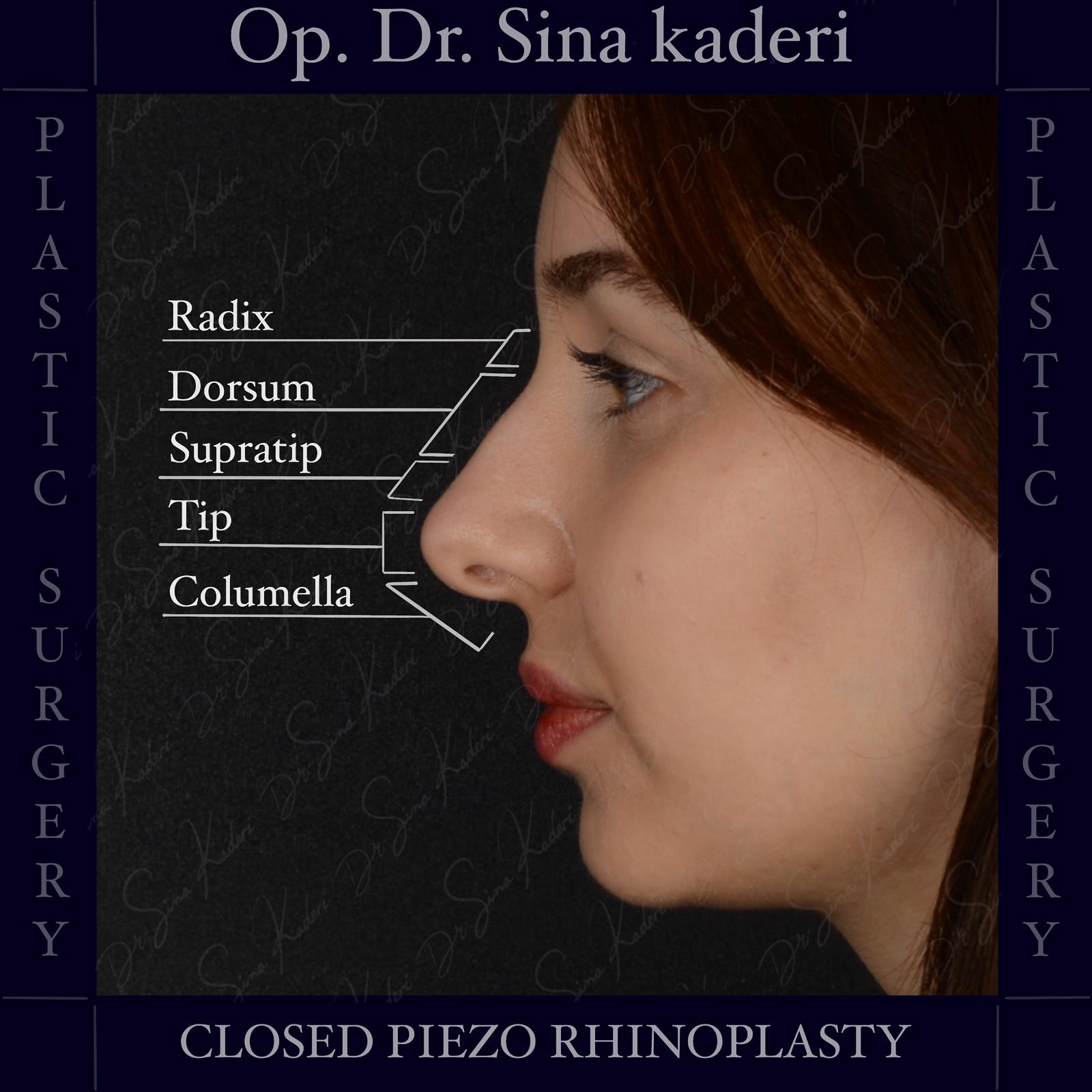 Kişiye Özel Tasarım: Kapalı Piezo Rinoplasti ile Doğal Burun Estetiği
