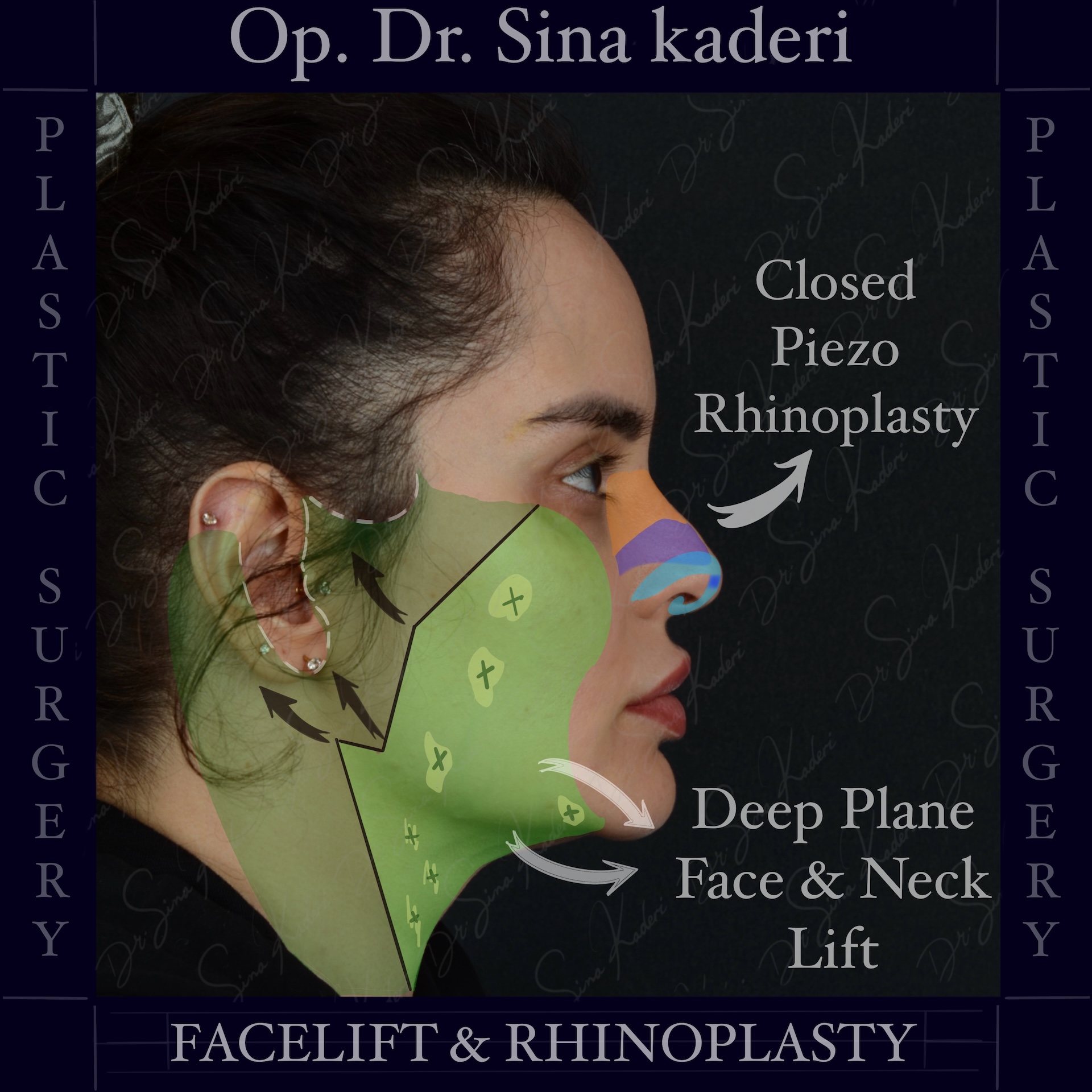 Derin Plan Yüz Germe ve Kapalı Piezo Rinoplasti: Yüzün Doğal Dengesini Yeniden Şekillendirmek