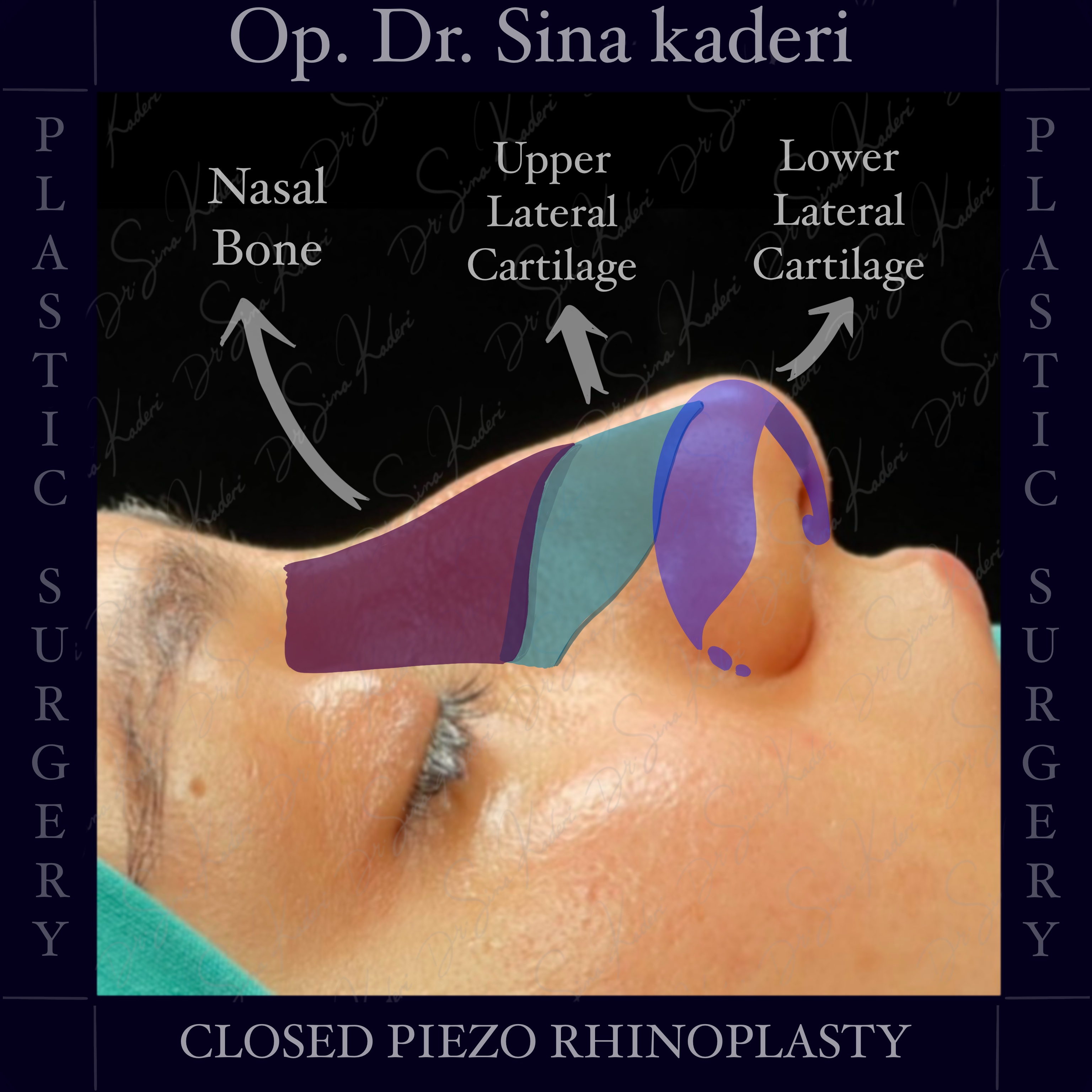 Kapalı Piezo Rinoplasti: Burun Estetiğinde Doğallık, Hassasiyet ve İz Bırakmayan Cerrahi