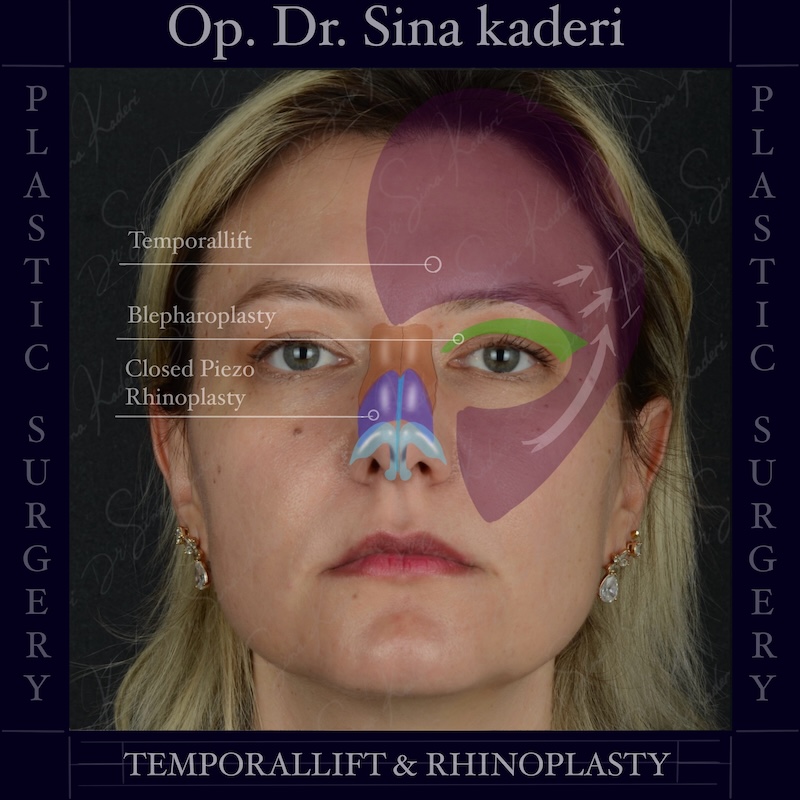 Temporal Lift, Blepharoplasty and Closed Piezo Rhinoplasty Combination