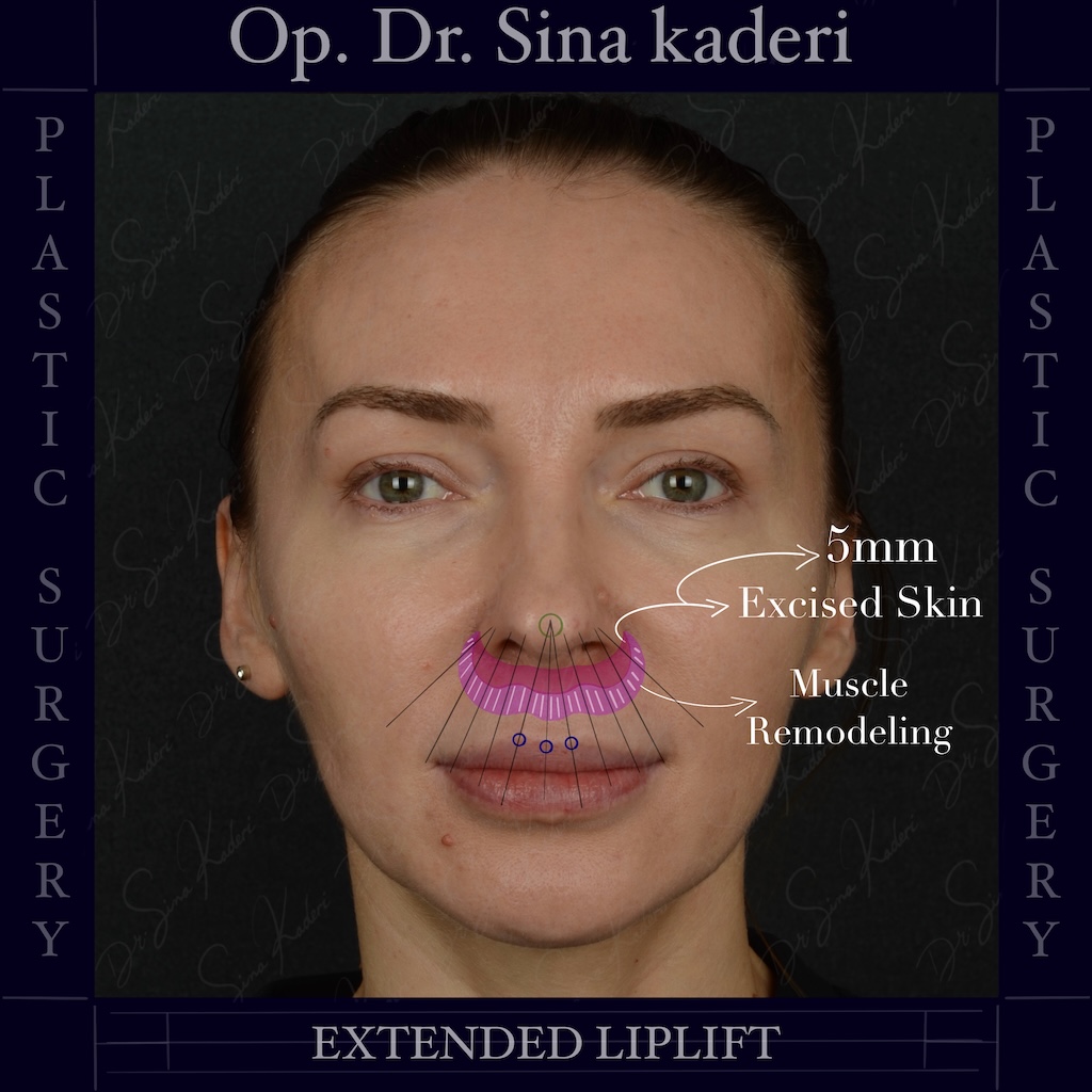 Extended Lip Lift: A Permanent Technique for a Balanced Face and a Natural Smile